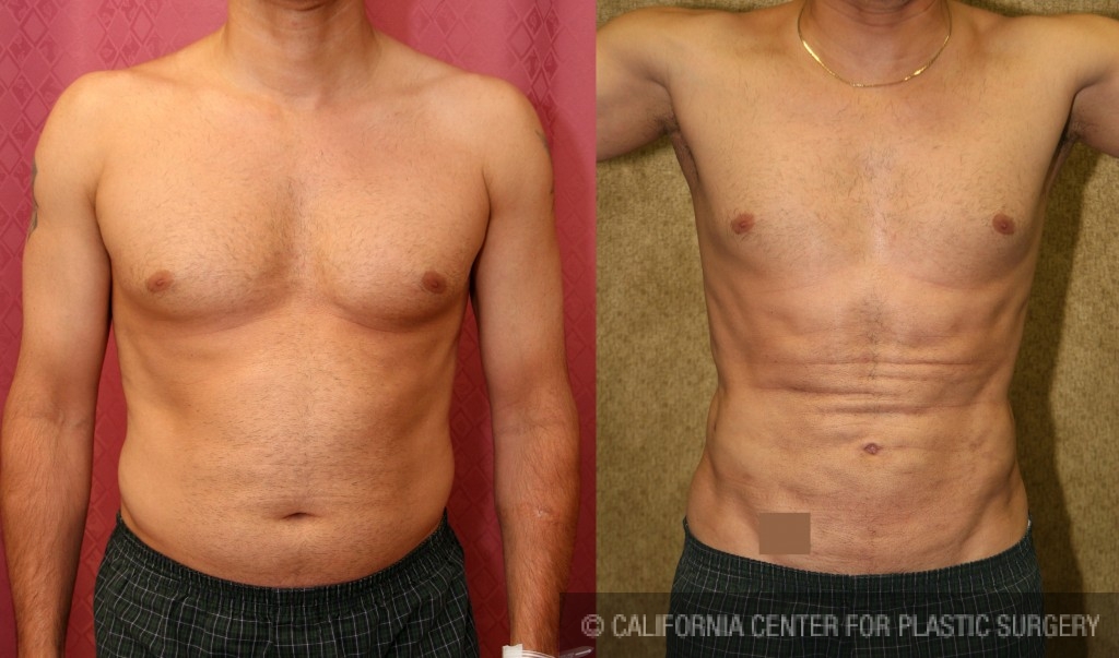 Patient Male Liposuction Abdomen Before And After Photos Beverly