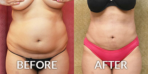 Revision liposuction – harder than you think!