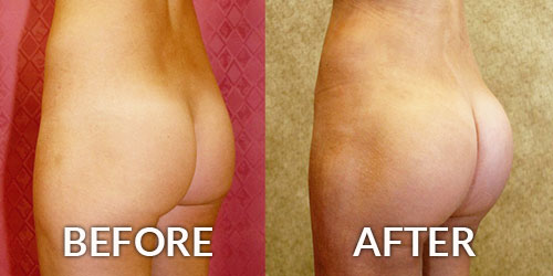 Liposuction Recovery