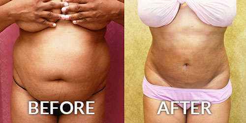 Remove your extra fat from your body in a snap with tummy tuck and make  your stunning physique. Book your appointment on…