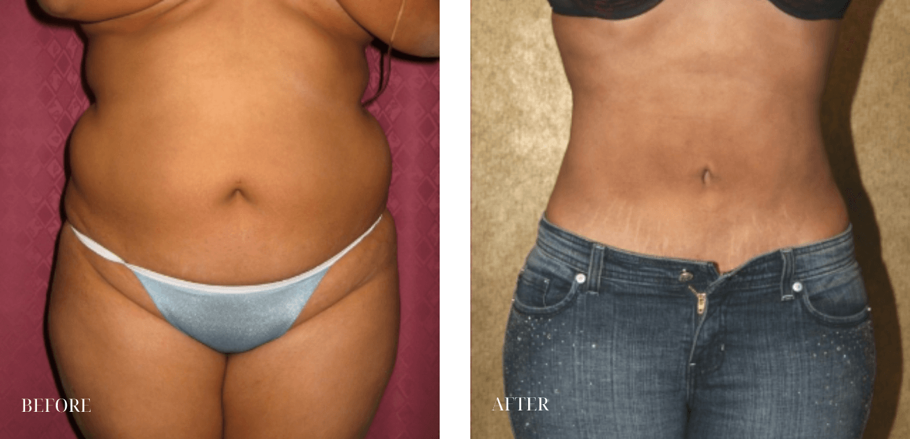 Patient #10965 Liposuction Abdomen Plus Size Before and After Photos  Beverly Hills - Plastic Surgery Gallery Los Angeles, CA - Dr. Sean Younai