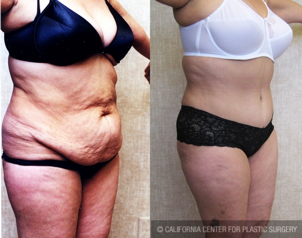 Before & After Pictures of Tummy Tuck