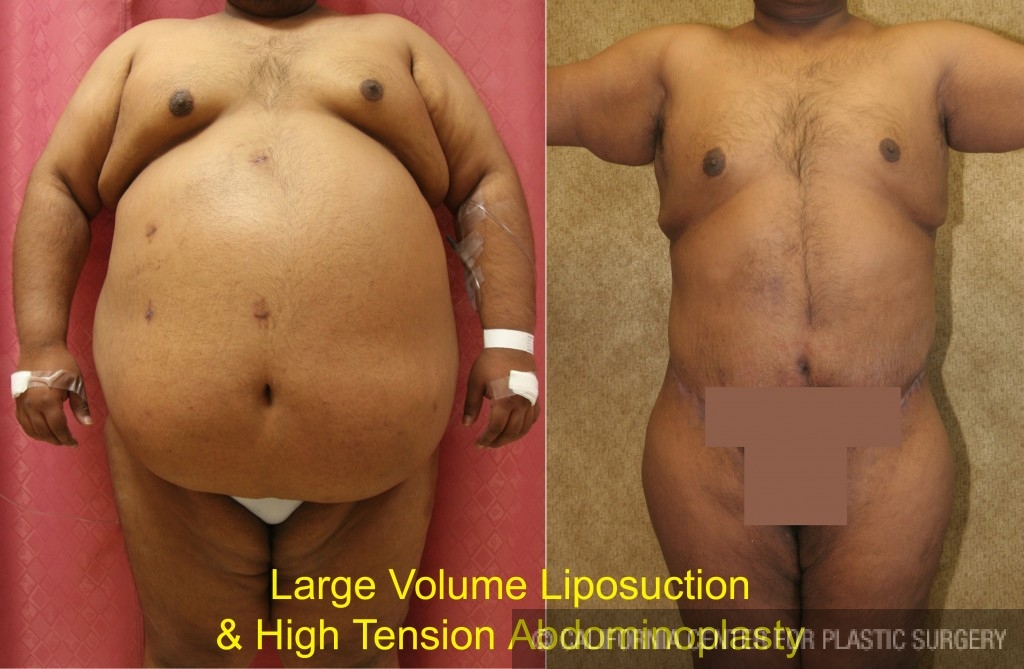 Tummy Tuck (Abdominoplasty) Before and After Photos
