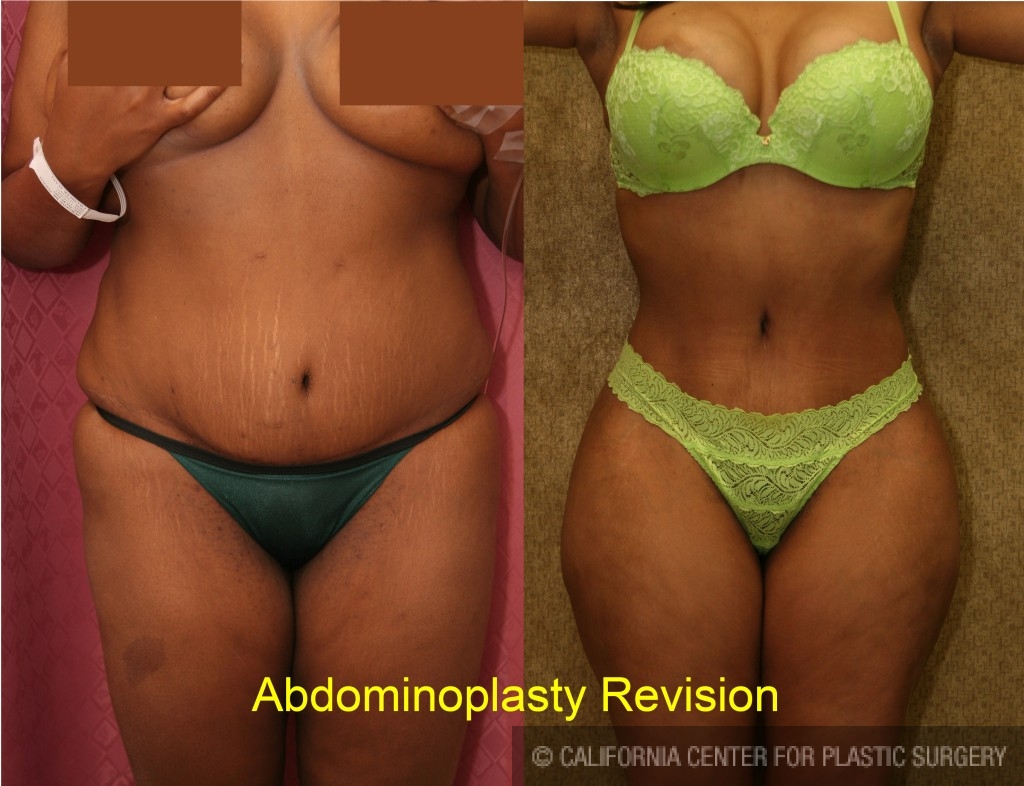 Patient #5760 Tummy Tuck (Abdominoplasty) Medium Size Before and