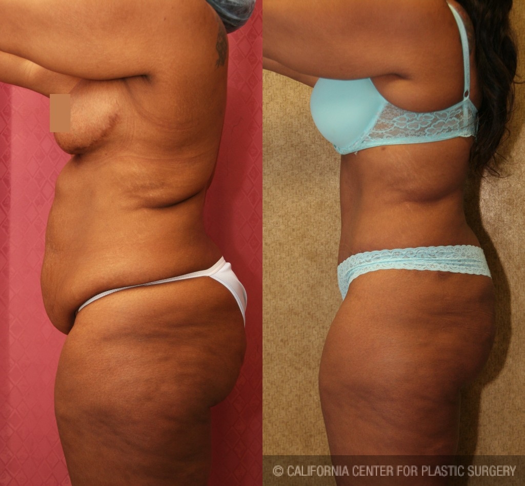 Patient #5924 African American Tummy Tuck (Abdominoplasty) Before and After  Photos Beverly Hills - Plastic Surgery Gallery Los Angeles, CA - Dr. Sean  Younai
