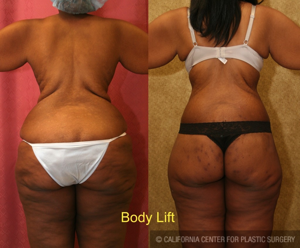 Lower Body Lift Before & After Patient 78, NYC