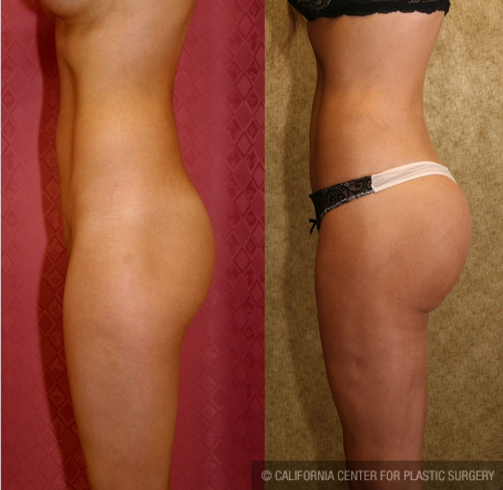 Butt Augmentation Before & After Gallery: Patient 3