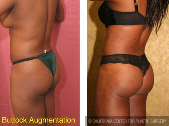 Shape Perfection, Buttock Augmentation in Los Angeles