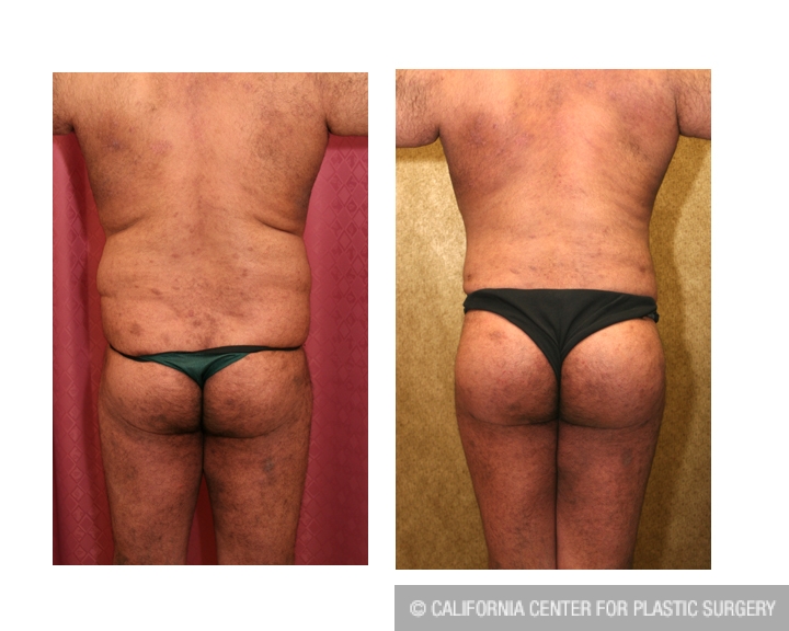 Buttock Augmentation/Brazilian Butt Lift Before and After Pictures