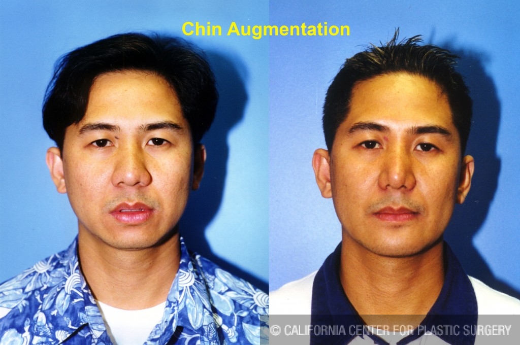 cleft chin removal before and after