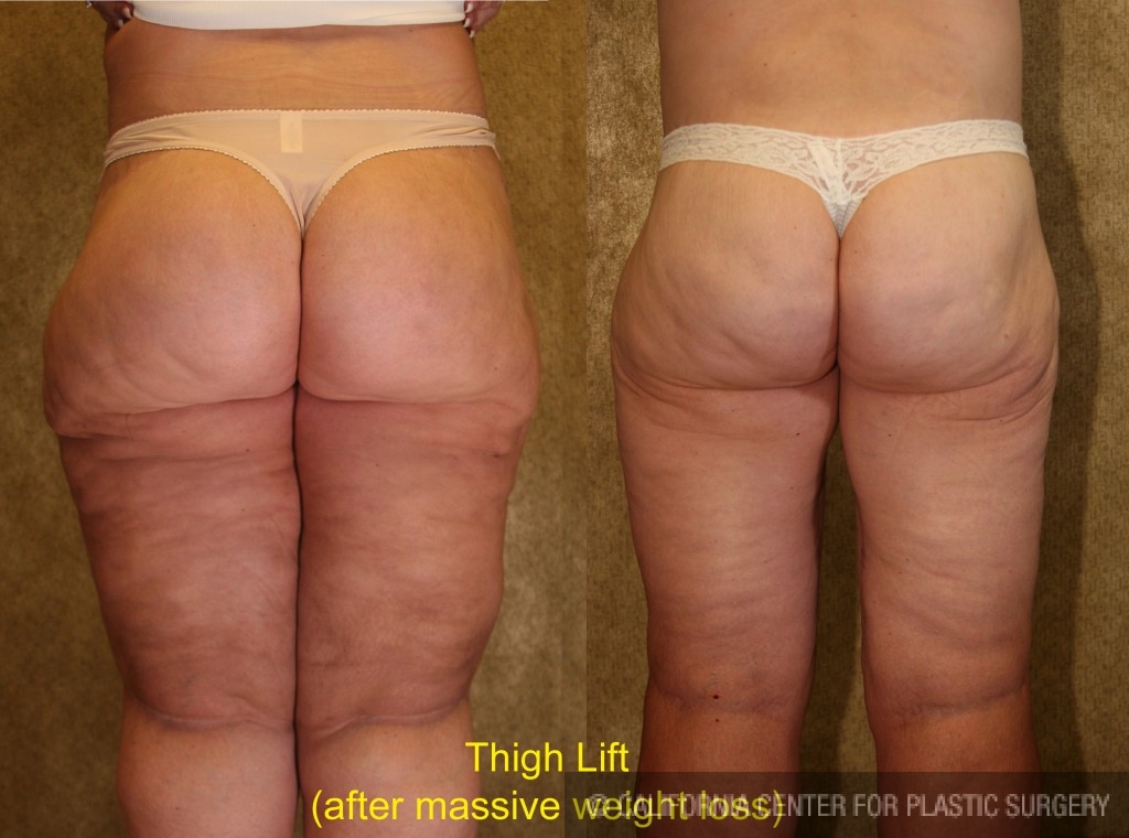Patient #4198 Thigh Lift Before and After Photos Beverly Hills - Plastic  Surgery Gallery Los Angeles, CA - Dr. Sean Younai