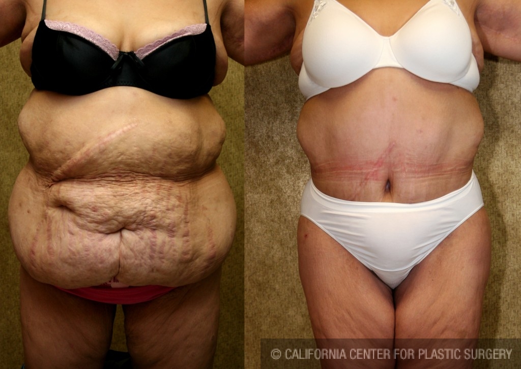 This Plus Size Tummy Tuck ® transformation is 🔥🔥🔥🔥 #plussize #plus