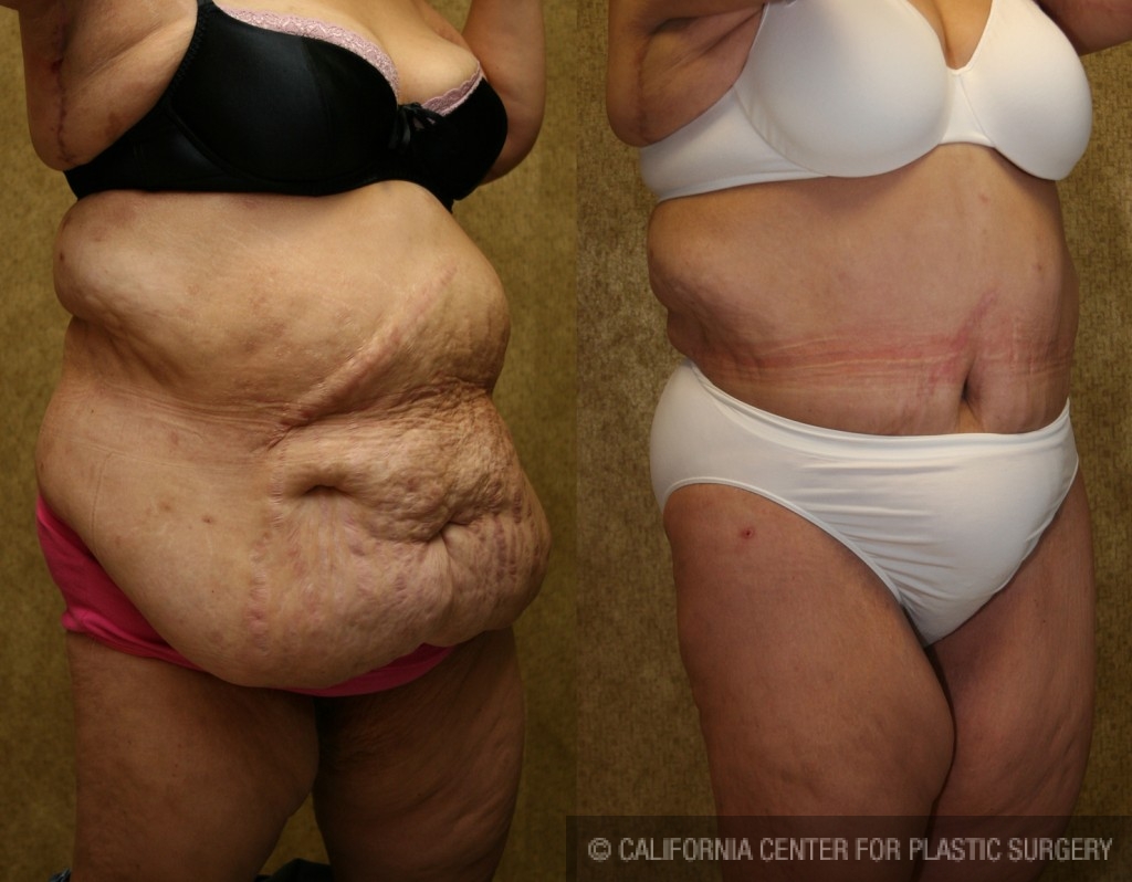 This Plus Size Tummy Tuck ® transformation is 🔥🔥🔥🔥 #plussize #plus