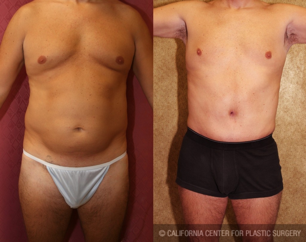 Tummy Tuck For Men Los Angeles & Beverly Hills