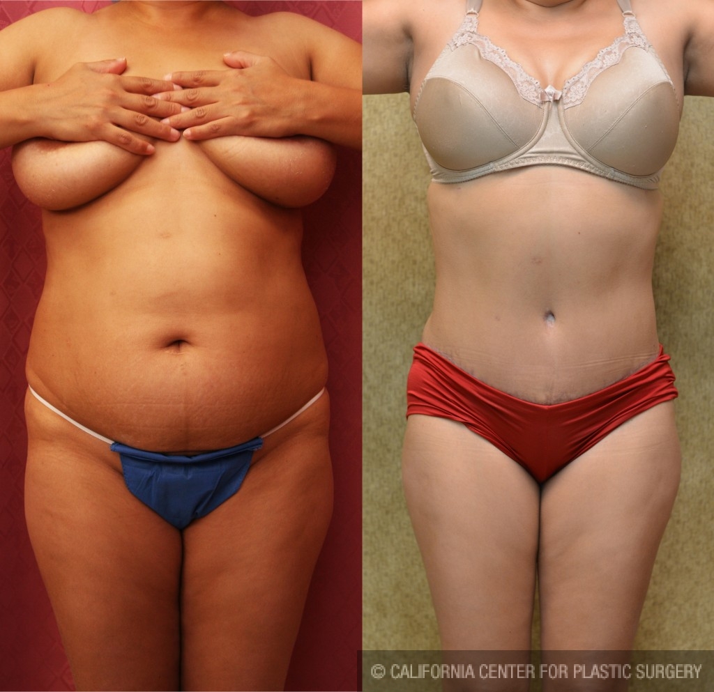 Patient #5888 Tummy Tuck (Abdominoplasty) Plus Size Before and After Photos  Beverly Hills - Plastic Surgery Gallery Los Angeles, CA - Dr. Sean Younai