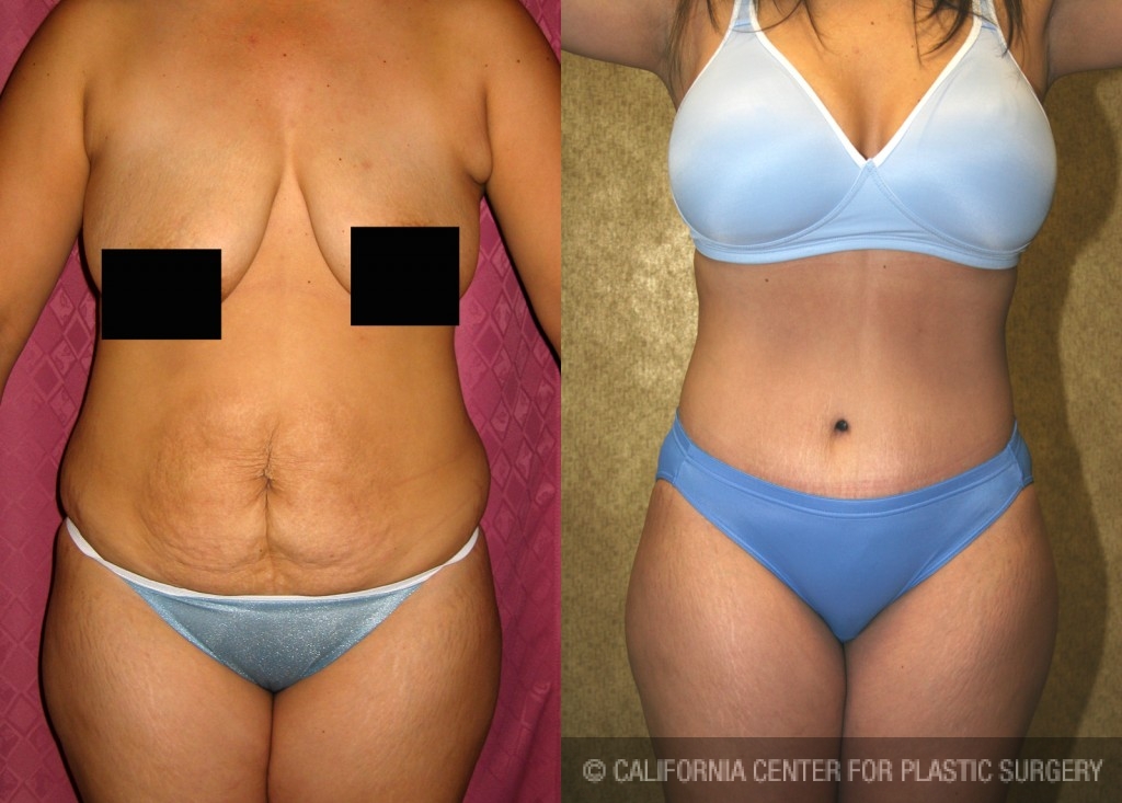 Mini Abdominoplasty Post Pregnancy Before & After