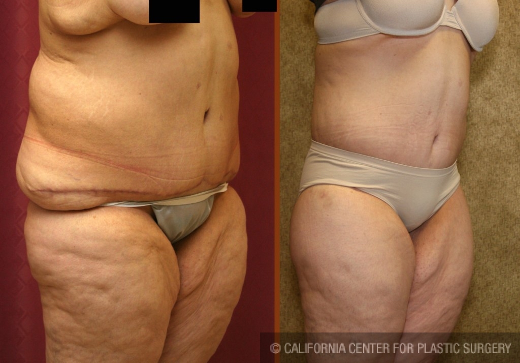 Patient #6047 Body Lift Before and After Photos Beverly Hills - Plastic  Surgery Gallery Los Angeles, CA - Dr. Sean Younai