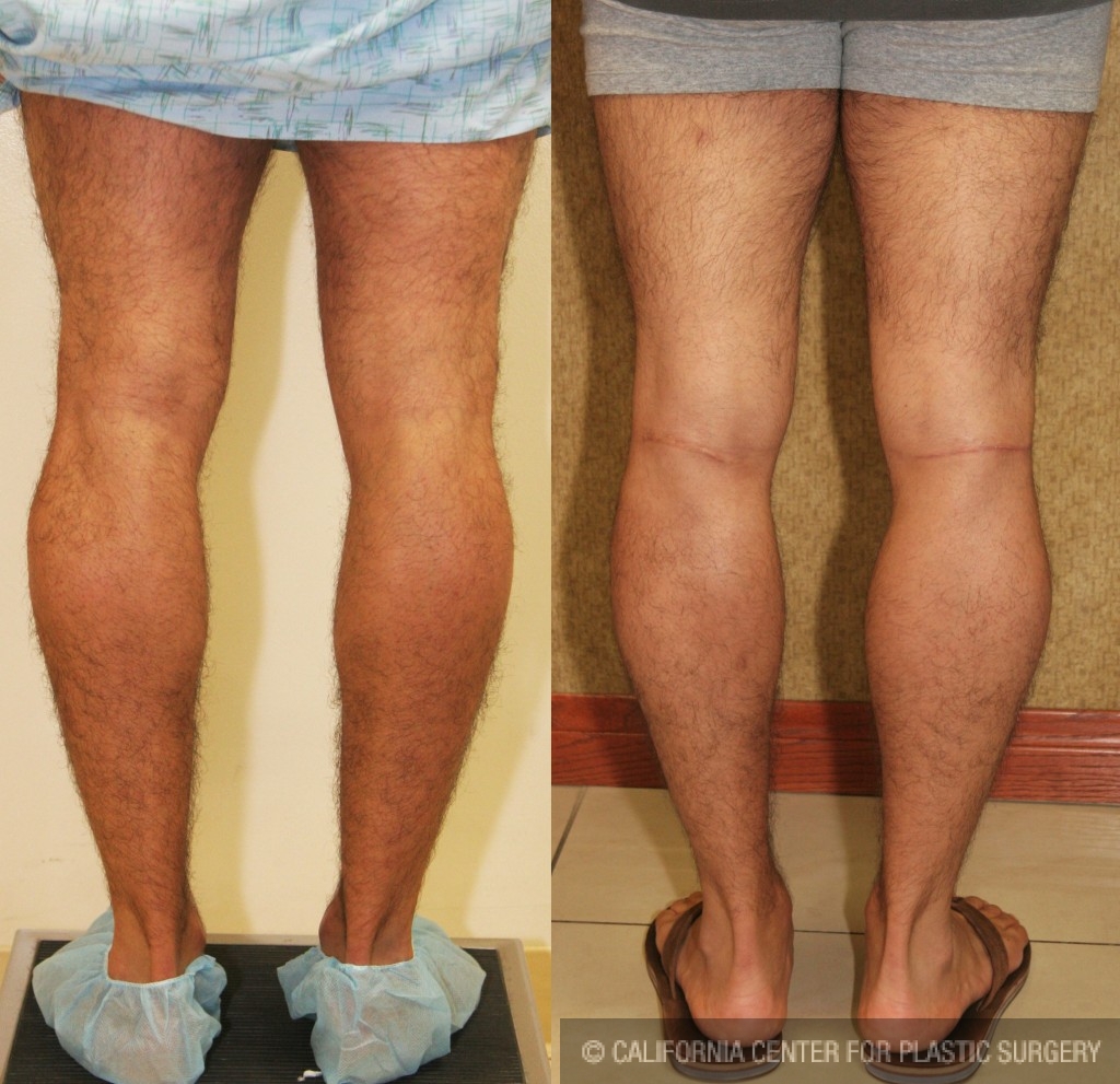Quick Recovery Tips after Calf Augmentation in Los Angeles
