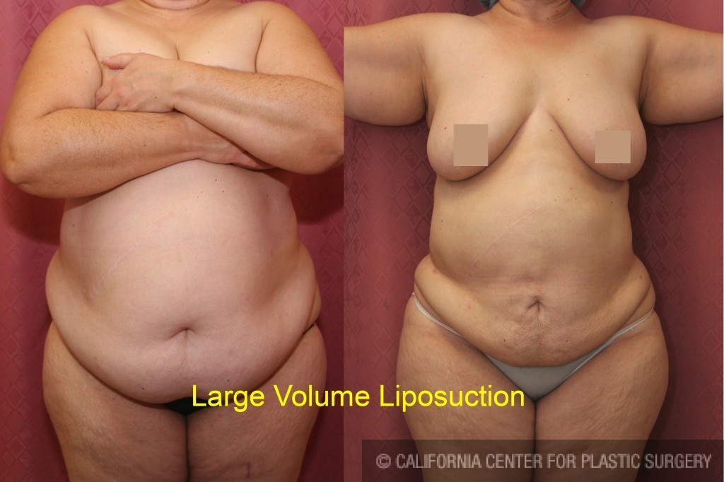 Liposuction in San Francisco  Liposculpture Procedure, Risks