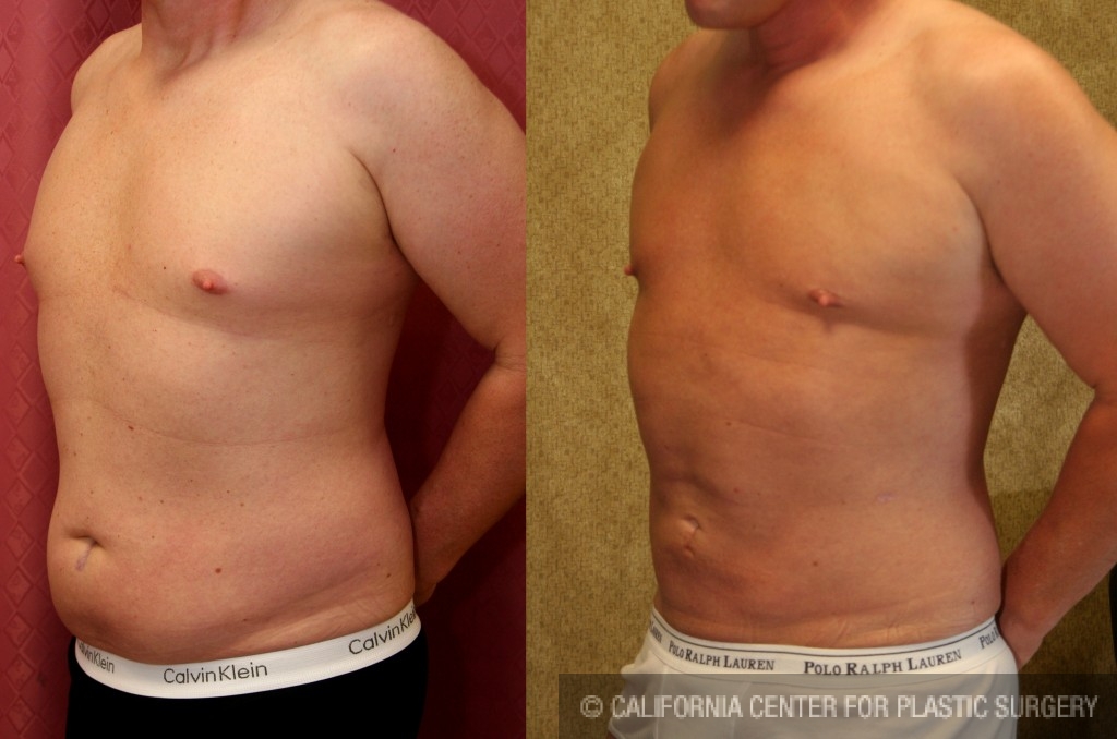 Liposuction for Men Before and After Photo Gallery, Los Angeles, CA