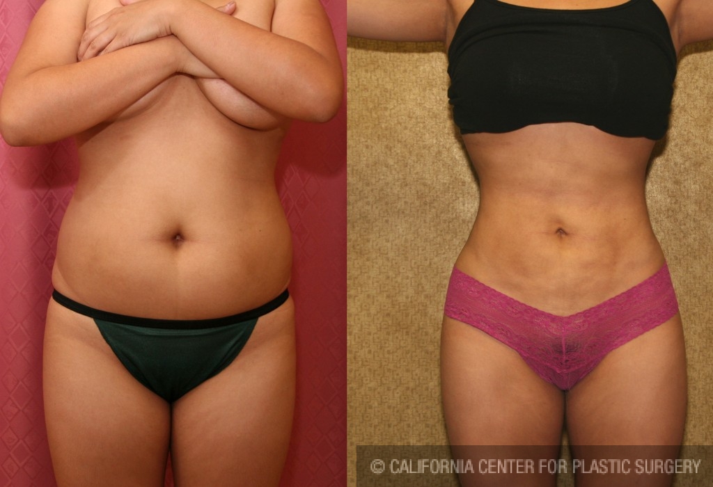Recovery After Liposuction - Dr. York Yates Plastic Surgery