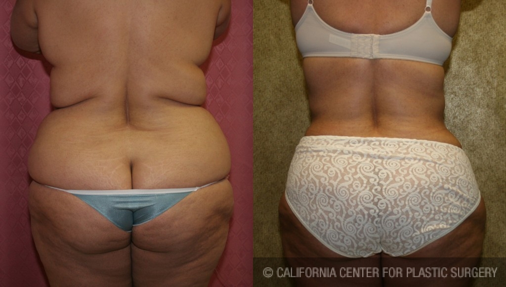 Liposuction - Before After Gallery