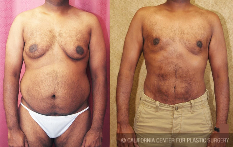 Patient #6805 Male gynecomastia (breast) reduction Before and