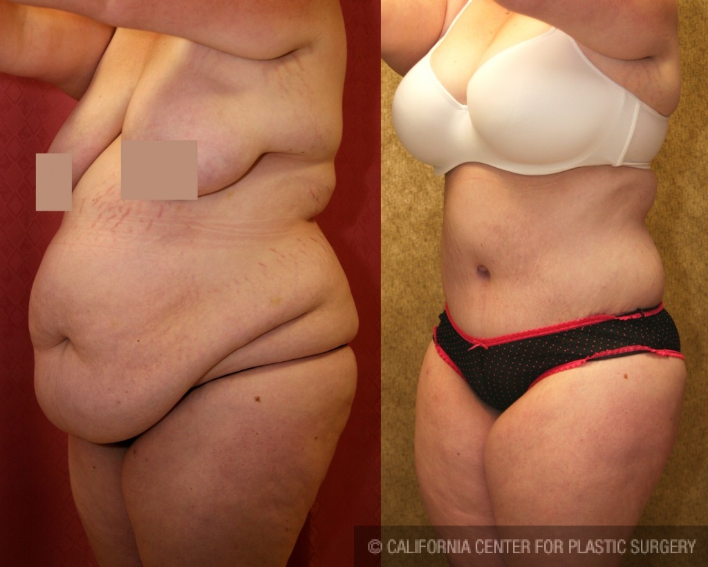 Can You Get a Plus Size Tummy Tuck?