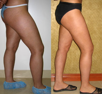 Patient #9439 Liposuction Thighs Before and After Photos Beverly Hills -  Plastic Surgery Gallery Los Angeles, CA - Dr. Sean Younai