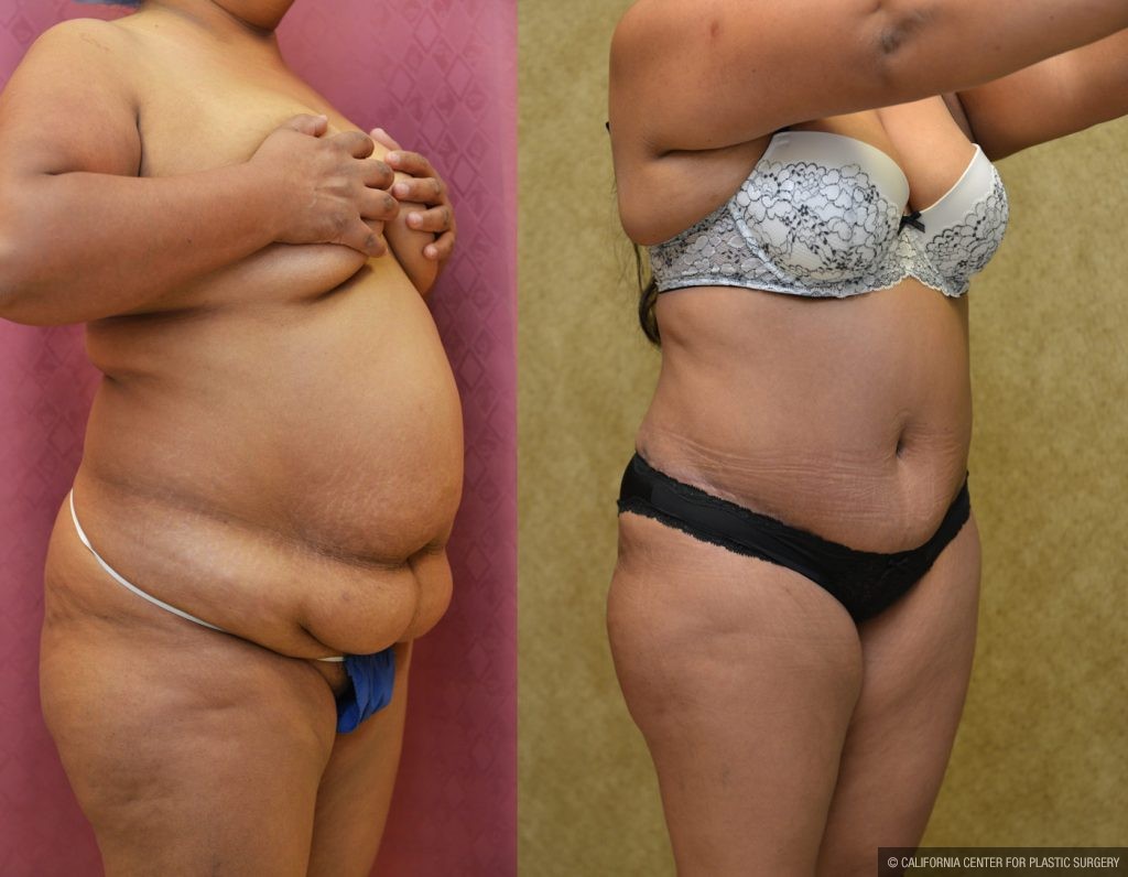 plus size tummy tuck before and after in Two Bridges Manhattan NYC