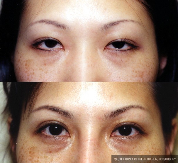 Patient #9886 Asian Eyelid Surgery 