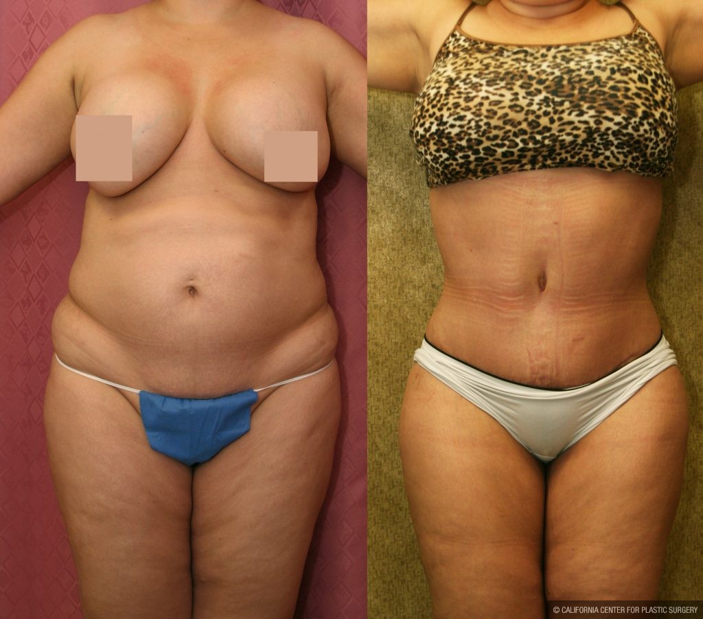 Body Contouring After Weight Loss Before and After Photo Gallery