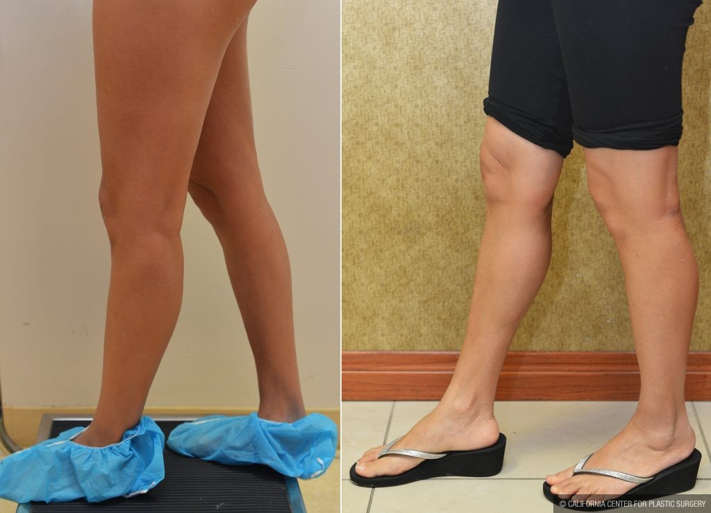 Calf Implant Recovery: Tips for Optimal Results