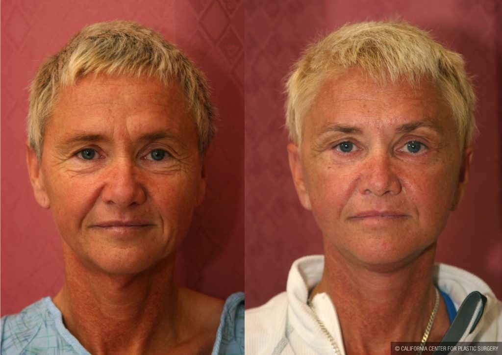 Patient #10940 Facelift Before and After Photos Beverly Hills - Plastic  Surgery Gallery Los Angeles, CA - Dr. Sean Younai