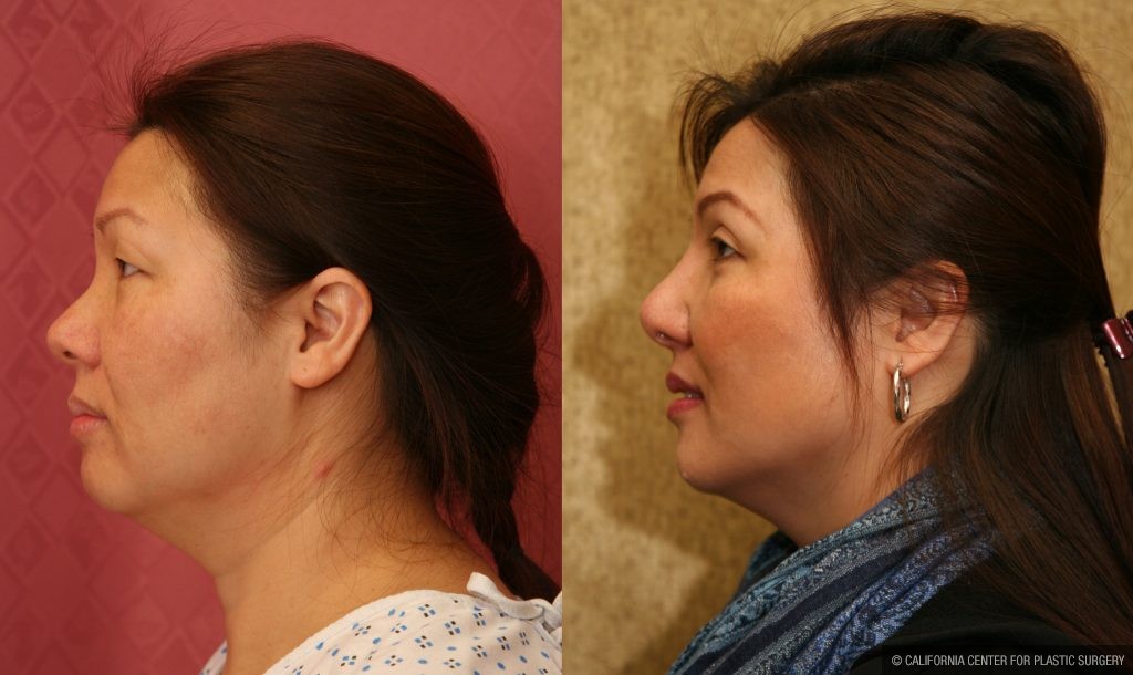 Patient Asian Rhinoplasty Before And After Photos Beverly Hills Plastic Surgery Gallery