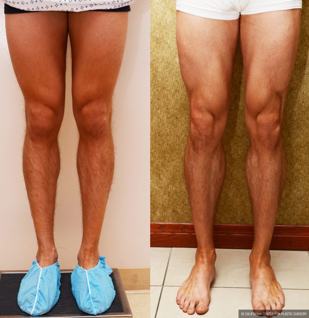 Quick Recovery Tips after Calf Augmentation in Los Angeles