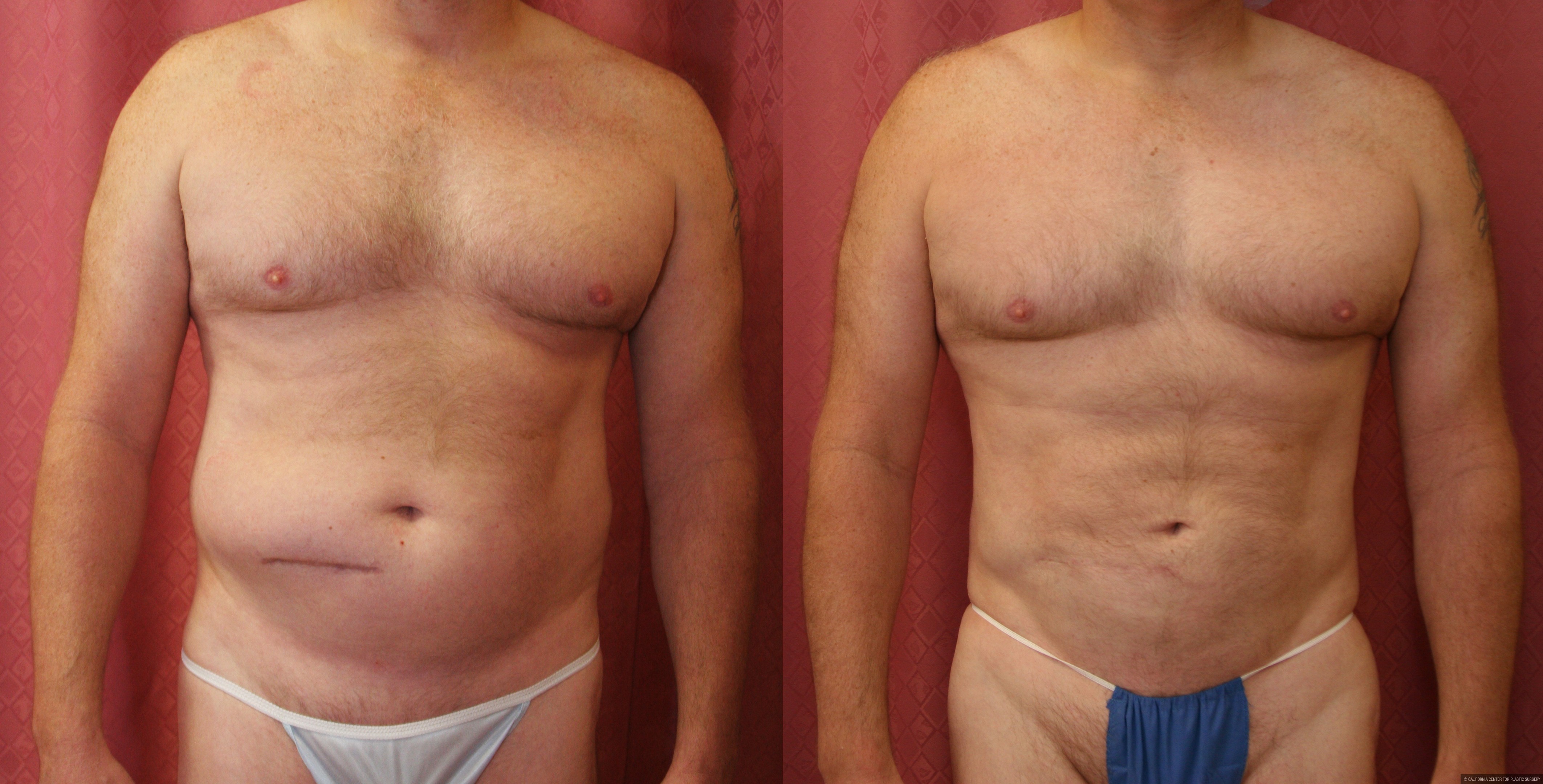 грудь у мужчин при ожирении фото 29