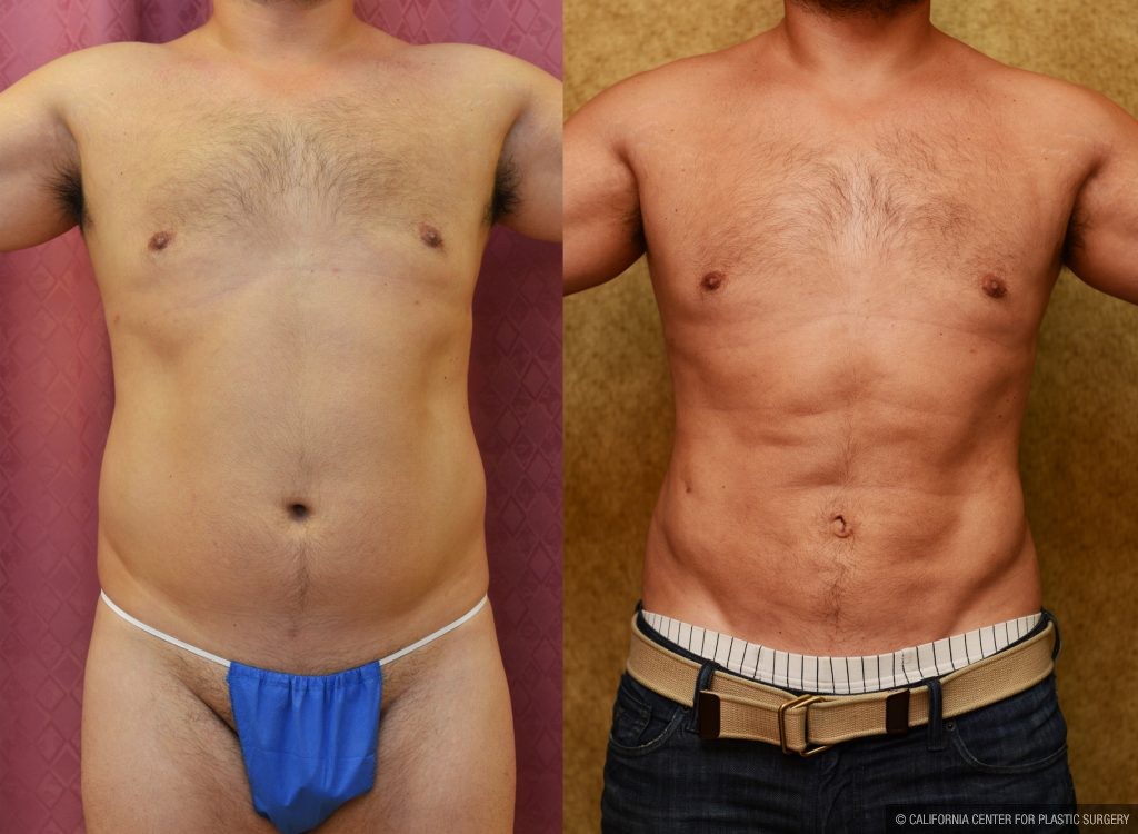 Лобковый жир у мужчин фото