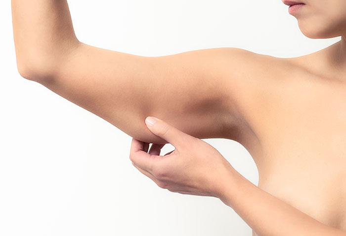 Arm Liposuction: Are the Results Permanent?
