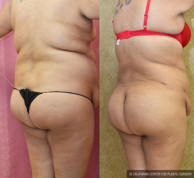 Brazilian Butt Lift Los Angeles  Beverly Hills Butt Augmentation