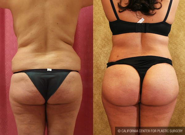Brazilian Butt Lift Before and After Photos Page 05 - Beverly Hills