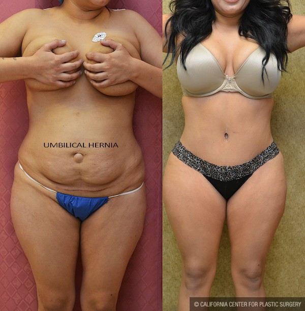 Patient #5760 Tummy Tuck (Abdominoplasty) Medium Size Before and After  Photos Beverly Hills - Plastic Surgery Gallery Los Angeles, CA - Dr. Sean  Younai