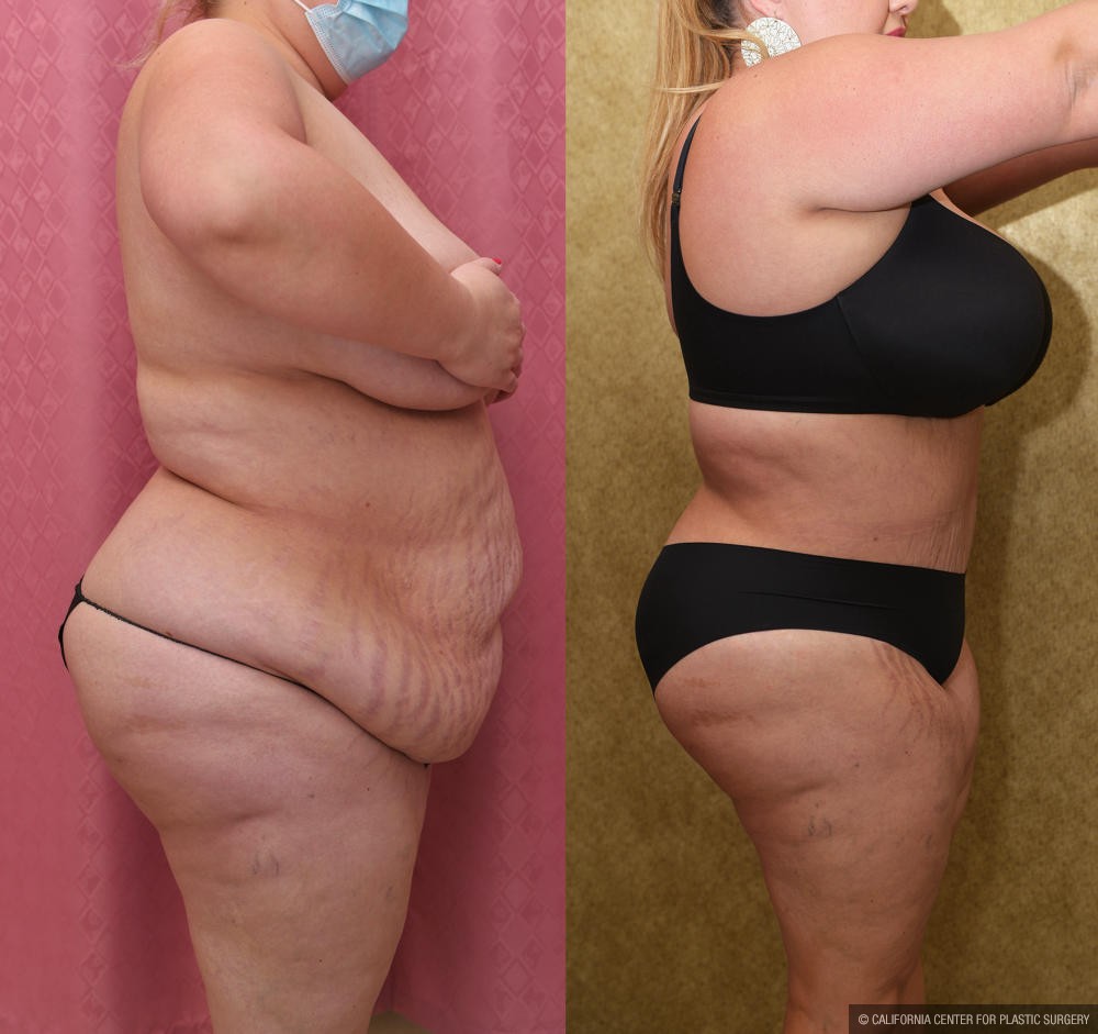 Plus Size Tummy Tuck Surgery Before & After Photo Gallery - Patient #61