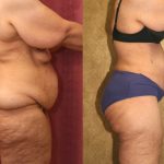 Patient #5888 Tummy Tuck (Abdominoplasty) Plus Size Before and After Photos  Beverly Hills - Plastic Surgery Gallery Los Angeles, CA - Dr. Sean Younai