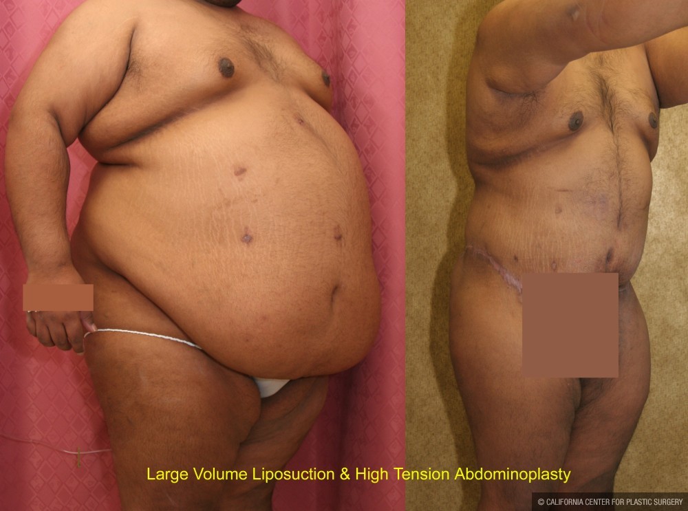 Patient #9794 Tummy Tuck (Abdominoplasty) Plus Size Before and After Photos  Beverly Hills - Plastic Surgery Gallery Los Angeles, CA - Dr. Sean Younai