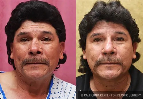 Rhinoplasty - Hispanic Before & After Patient #13701