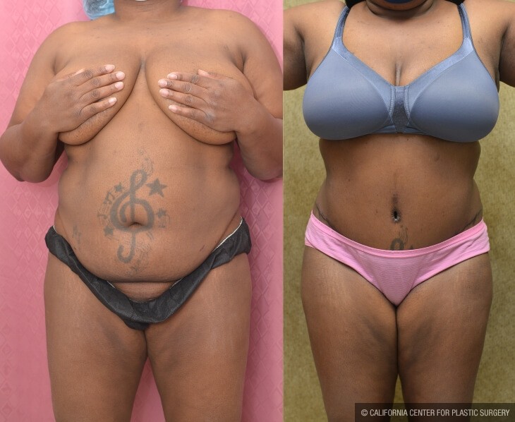 Tummy Tuck (Abdominoplasty) Plus Size Before and After Photos