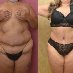 Tummy Tuck (Abdominoplasty) Plus Size Before and After Photos Beverly Hills  - Plastic Surgery Gallery Los Angeles, CA - Dr. Sean Younai