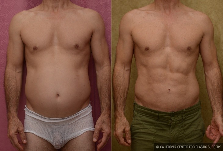 Male Liposuction Abdomen Before & After Patient #14108