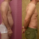 Male Liposuction Abdomen Before & After Patient #14108